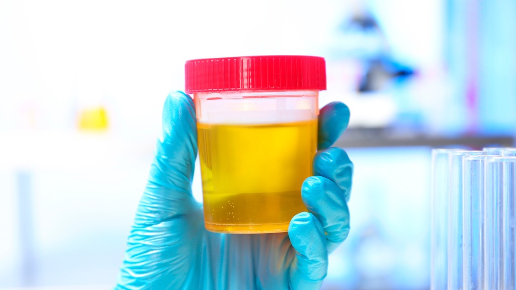 Examen General de Orina (EGO)