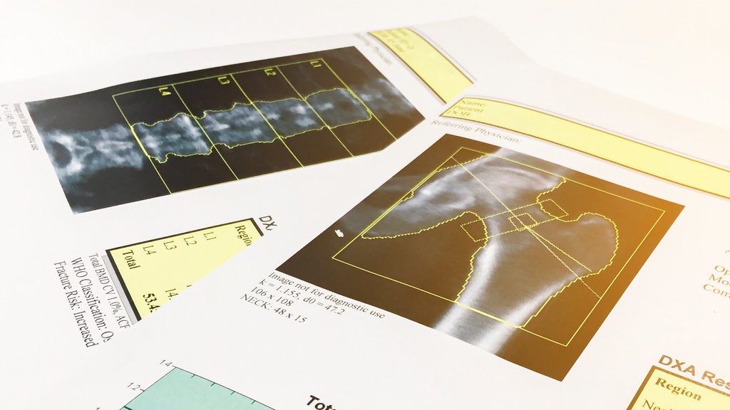 Densitometría 2 Regiones