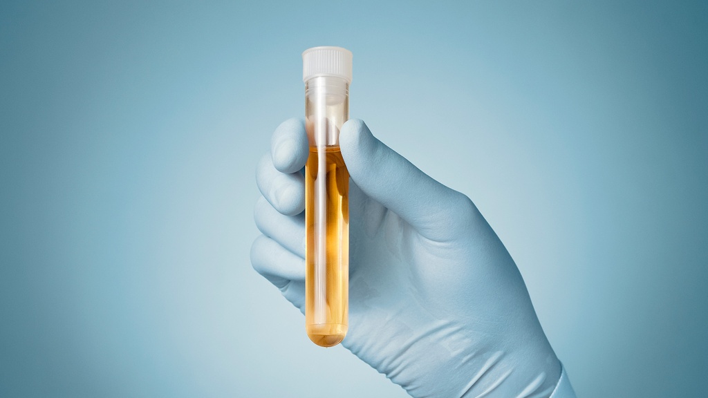 Albúmina en Orina de 24 h