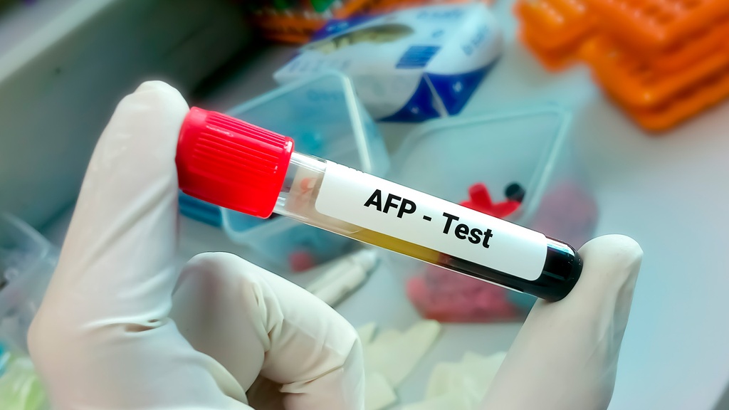 Alfa - Feto Proteína